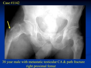 Case #1142




38 year male with metastatic testicular CA & path fracture
                right proximal femur
 
