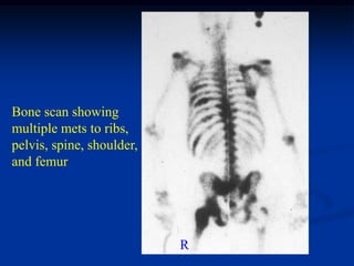 Bone scan showing
multiple mets to ribs,
pelvis, spine, shoulder,
and femur




                           R
 