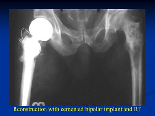 Rconstruction with cemented bipolar implant and RT
 