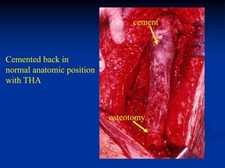 cement



Cemented back in
normal anatomic position
with THA



                           osteotomy
 