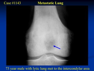 Case #1143             Metastatic Lung




 73 year male with lytic lung met to the intercondylar area
 