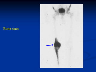 Bone scan
 