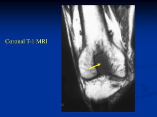 Coronal T-1 MRI
 