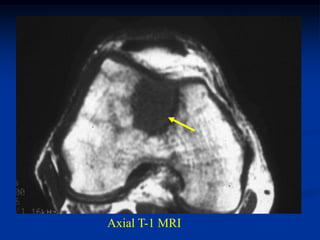 Axial T-1 MRI
 