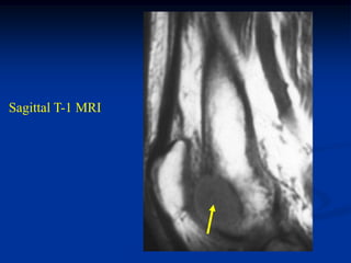 Sagittal T-1 MRI
 