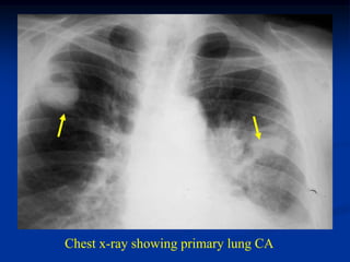Chest x-ray showing primary lung CA
 