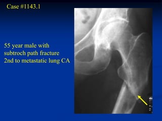 Case #1143.1




55 year male with
subtroch path fracture
2nd to metastatic lung CA
 