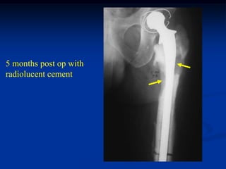5 months post op with
radiolucent cement
 