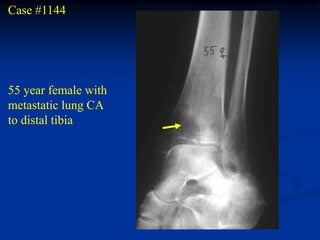 Case #1144




55 year female with
metastatic lung CA
to distal tibia
 