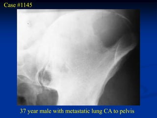 Case #1145




     37 year male with metastatic lung CA to pelvis
 