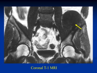 Coronal T-1 MRI
 