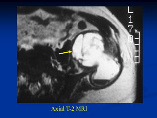 Axial T-2 MRI
 