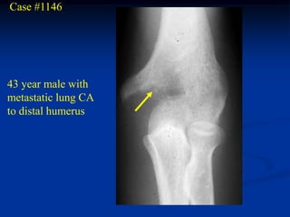 Case #1146




43 year male with
metastatic lung CA
to distal humerus
 