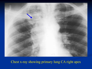 Chest x-ray showing primary lung CA right apex
 
