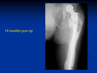 18 months post op
 