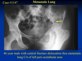 Case #1147             Metastatic Lung




46 year male with central fracture dislocation thru metastatic
          lung CA of left peri-acetabular area
 