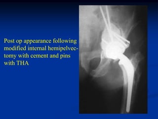 Post op appearance following
modified internal hemipelvec-
tomy with cement and pins
with THA
 