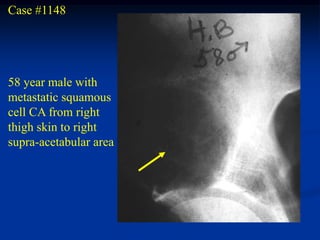 Case #1148




58 year male with
metastatic squamous
cell CA from right
thigh skin to right
supra-acetabular area
 
