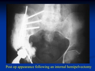 Post op appearance following an internal hemipelvectomy
 