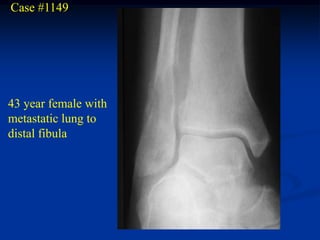 Case #1149




43 year female with
metastatic lung to
distal fibula
 