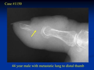 Case #1150




    44 year male with metastatic lung to distal thumb
 