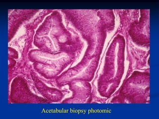 Acetabular biopsy photomic
 