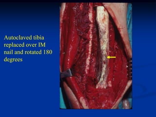 Autoclaved tibia
replaced over IM
nail and rotated 180
degrees
 