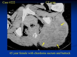 Case #222                       CT scan




     65 year female with chordoma sacrum and buttock
 