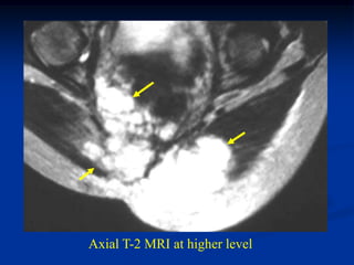 Axial T-2 MRI at higher level
 