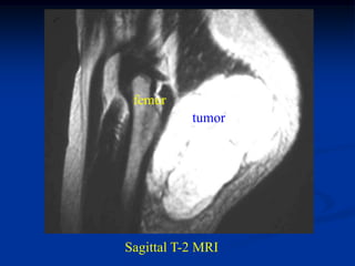 femur
           tumor




Sagittal T-2 MRI
 