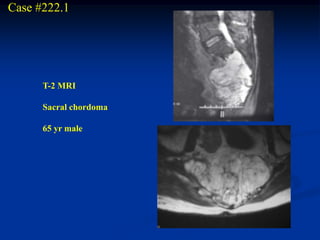 Case #222.1




      T-2 MRI

      Sacral chordoma

      65 yr male
 