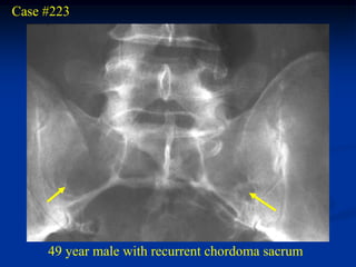 Case #223




     49 year male with recurrent chordoma sacrum
 
