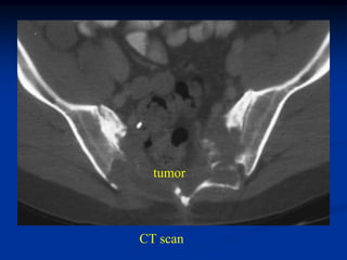 tumor



CT scan
 