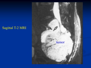 Sagittal T-2 MRI



                   tumor
 