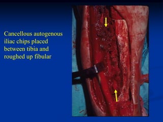 Cancellous autogenous
iliac chips placed
between tibia and
roughed up fibular
 