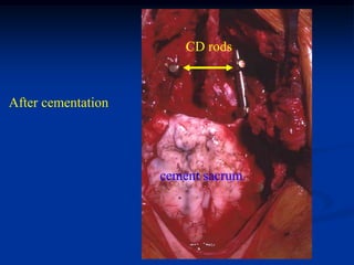 CD rods



After cementation




                    cement sacrum
 