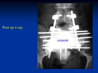 Post op x-ray


                cement
 