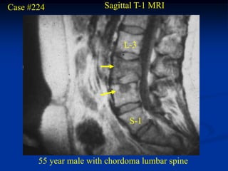 Case #224               Sagittal T-1 MRI



                             L-3




                              S-1



       55 year male with chordoma lumbar spine
 