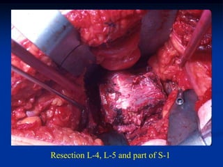 Resection L-4, L-5 and part of S-1
 