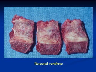 Resected vertebrae
 
