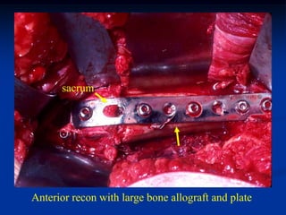 sacrum




Anterior recon with large bone allograft and plate
 