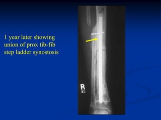 1 year later showing
union of prox tib-fib
step ladder synostosis
 