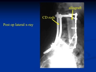 allograft

                        CD rods
Post op lateral x-ray
 