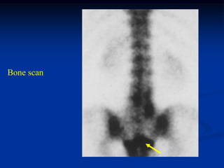 Bone scan
 