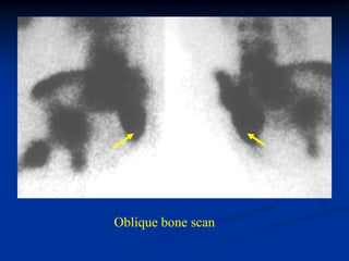 Oblique bone scan
 