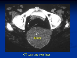 tumor




CT scan one year later
 