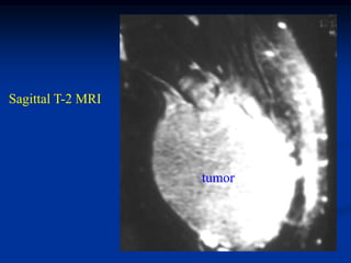 Sagittal T-2 MRI




                   tumor
 