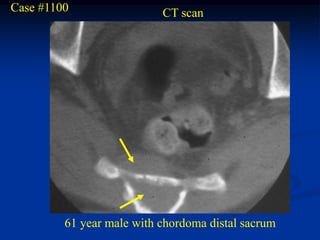 Case #1100                 CT scan




         61 year male with chordoma distal sacrum
 