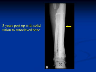 3 years post op with solid
union to autoclaved bone
 