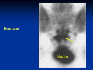 Bone scan




            bladder
 
